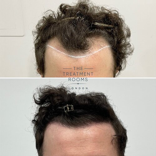 FUE Hairline Restoration 1306 Grafts- The Treatment Rooms London photo