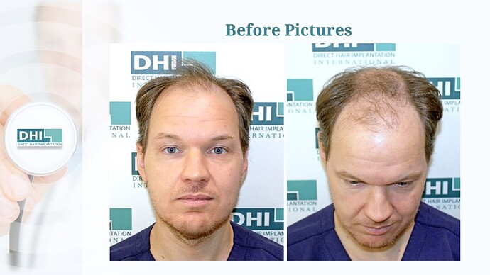 DHI India™ | NW 6 | 2,507 Grafts | 4 Months Hair Transplant Results photo