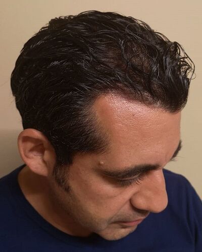 Dr. Bisanga, BHR Clinic, 3157 FUE / 0-10 Months photo