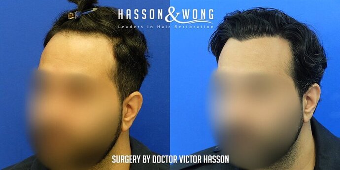 Dr. Hasson / 2,500 grafts / FUE / Hairline / 1 Year Post-op photo