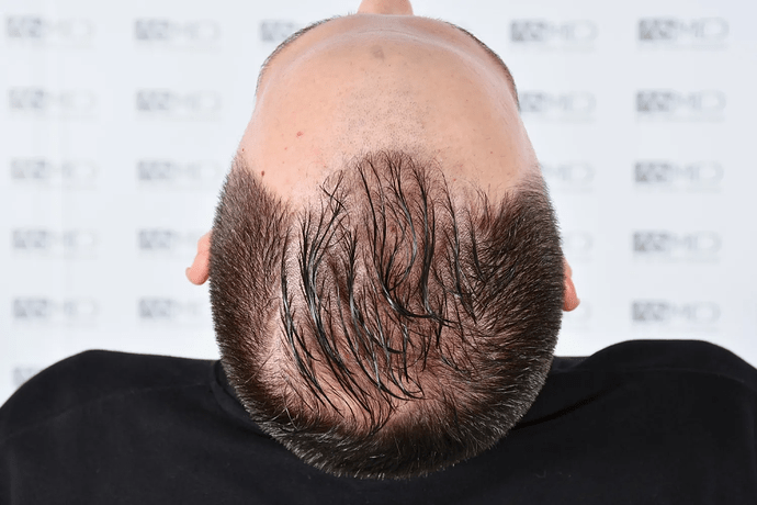 ASMED, Istanbul: 5,071 Manual FUE Grafts 0/12 Months photo