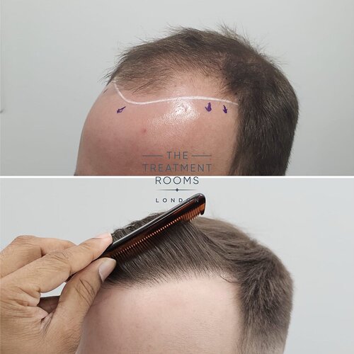 Result- Frontal Third FUE Hair Transplant- 2187 Grafts photo