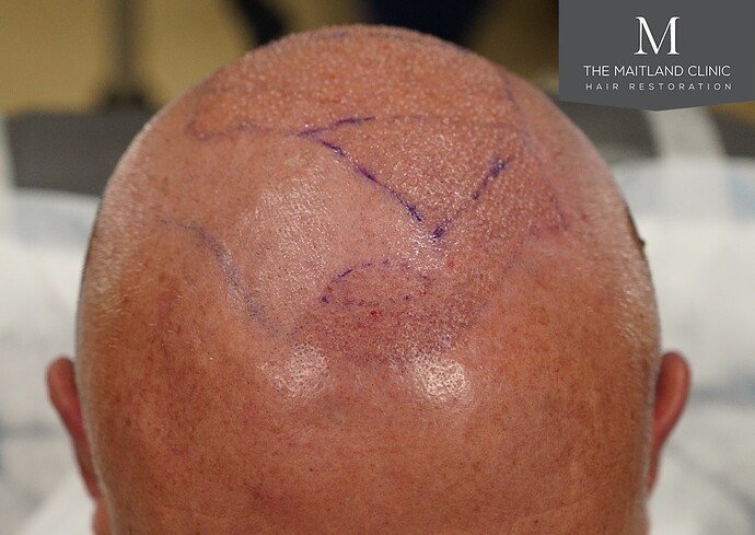 Dr Ball - The Maitland Clinic 2280 Grafts by FUE photo