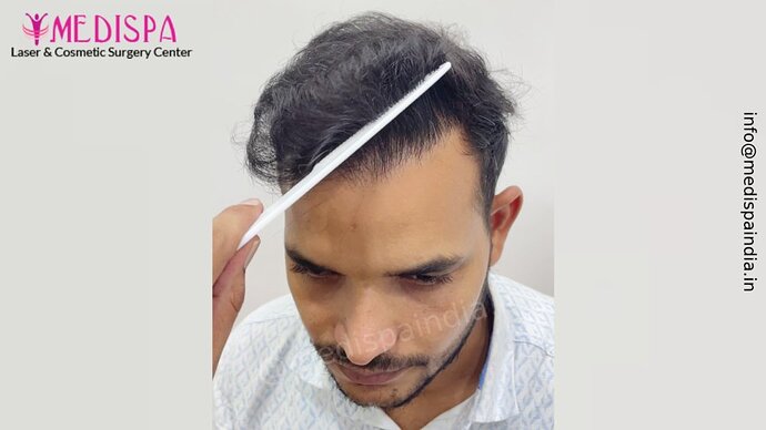 Dr. Suneet Soni - 5294 Grafts, Combine FUT + FUE + Beard Technique, NW- VI, 2 Years Result photo