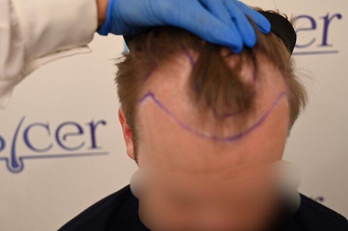 Ozlem Bicer MD-Hair Transplant-2720 Grafts FUE by micro-motor, 9. months result photo