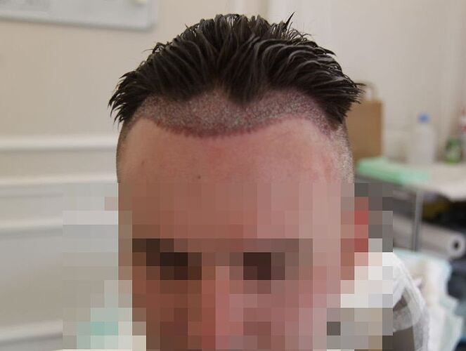 Dr.Bisanga, BHR Clinic, 1675 FUE, 0 - 13 Months photo