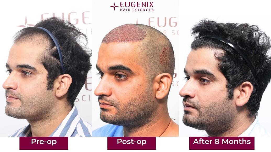 https://cdn.forumhairtransplant.com/optimized/3X/b/5/b511a8d7814ccf4294fb4499cfe5738a1551eb94_2_1035x582.jpeg