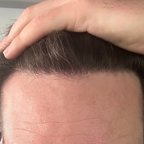 Dr. Bisanga & Dr. Kostis - 2955 FUE - 9 Months - Front & Crown photo