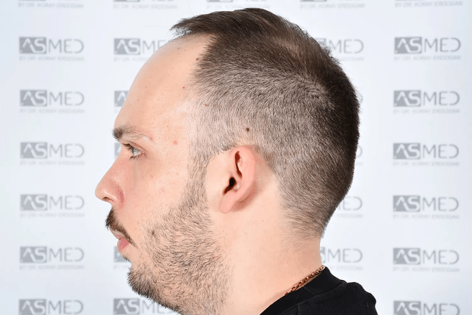 ASMED, Istanbul: 5,071 Manual FUE Grafts 0/12 Months photo