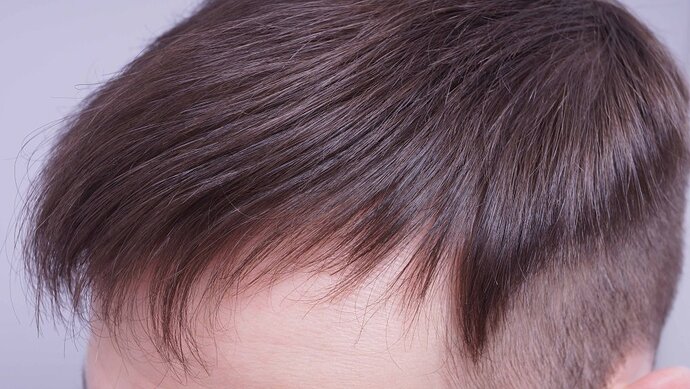 Dr B Farjo 1560g FUE (Frontal) photo