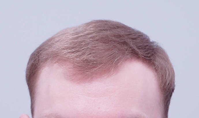 Dr B Farjo 1820 FUE (Fontal) Very early growth. photo