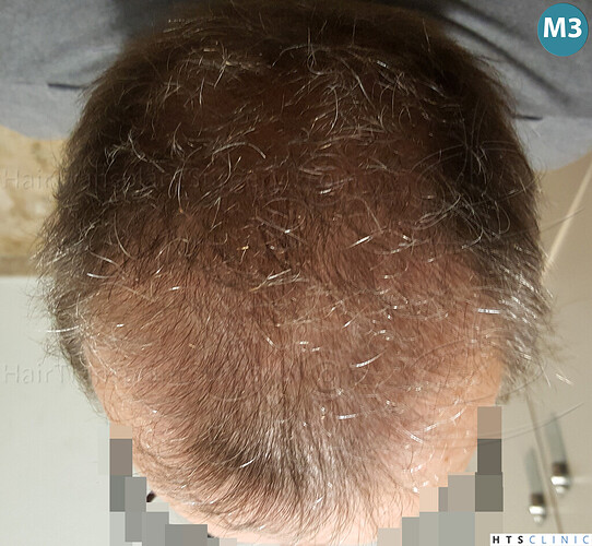 Dr Devroye + Dr Montesanti + Dr Jenard / 7015 grafts (4512 FUT + 2503 FUE) / 2 sessions photo