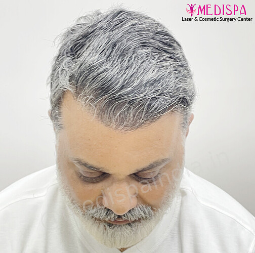 Dr. Suneet Soni - 4190 Grafts, Combine FUT + FUE + Beard Technique, NW- III photo