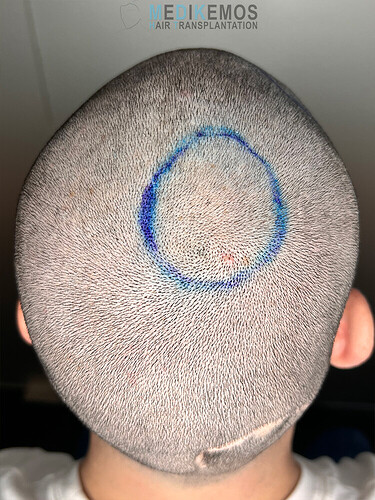 CASE DR. LUPANZULA: 2538 UFS, FUE - TEMPLES-HAIRLINE/CROWN photo