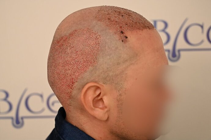 Ozlem Bicer MD-Hair Transplant-3980 Grafts FUE by micro-motor, 12. months result photo