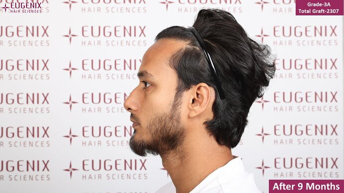EUGENIX HAIR SCEINCES | GRADE 3A | 9 MONTHS RESULT photo