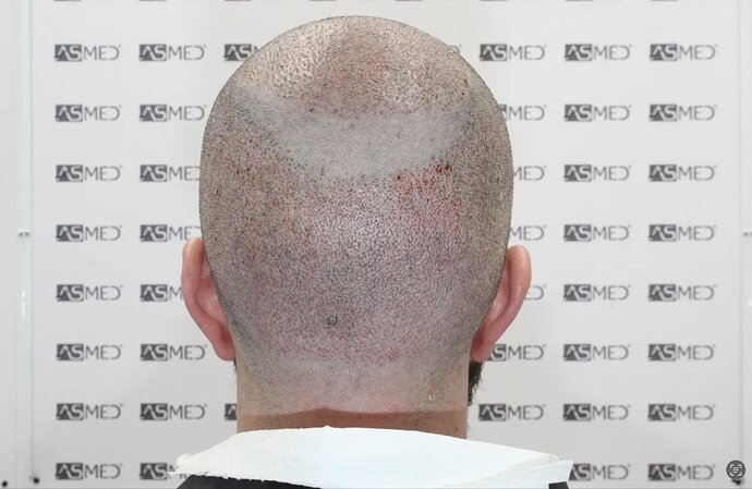 ASMED CLINIC CASE - DR.KORAY 5000 GRAFTS FUE photo