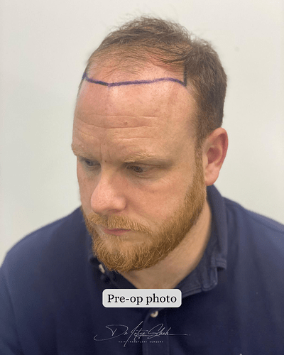 Dr Shah (London, UK) 3114 FUE grafts (0-12 months) photo