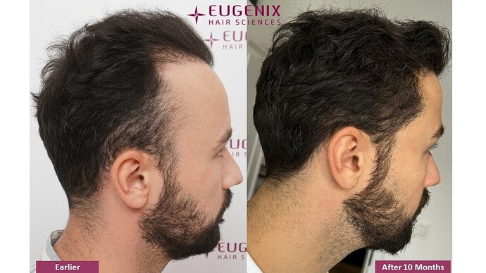 Dr. Somesh| Eugenix Hair Sciences Clinic | NW 3 | 3007 Grafts | 10 Months Post-op photo