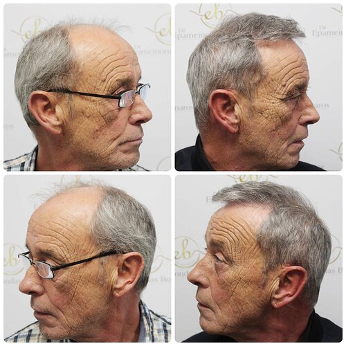 Dr Bonaros, Glasgow, UK / 3524 FUE grafts / 0-12 Months photo