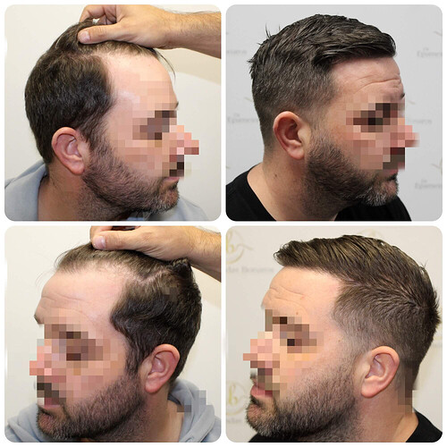Dr Bonaros, Glasgow, UK / Receding Hairline Hair Transplant Result / 1446 FUE grafts / 0-12 Months photo