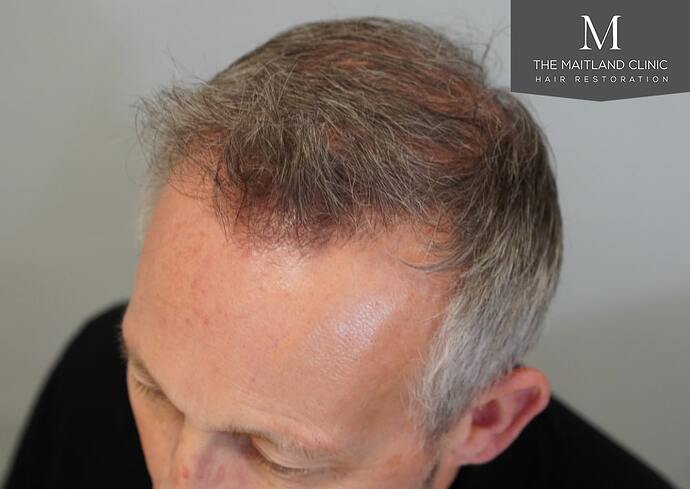 Dr Ball - The Maitland Clinic 2448 Grafts By FUT photo