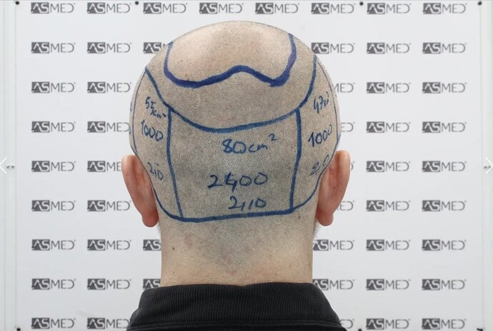 Asmed Clinic - FUE Hair Transplant - 5041 Grafts photo