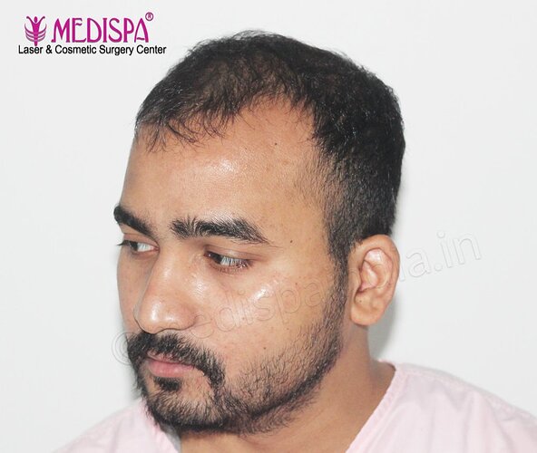 Dr. Suneet Soni - 4500 Grafts, Combine FUT + FUE + Beard Technique , NW- IV photo