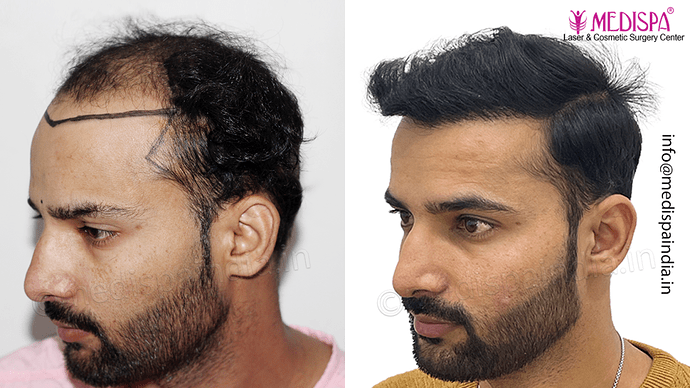 Dr. Suneet Soni - 4046 Grafts | 12-Month Result | Combination FUT + FUE + Beard photo