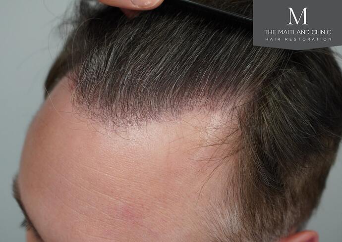 Dr Ball - The Maitland Clinic 2032 Grafts By FUE photo