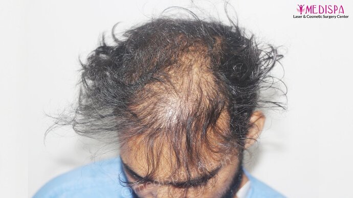 Revision Hair Transplant - 5111 Grafts / 5 Years Result - Dr. Suneet Soni, Medispa India photo