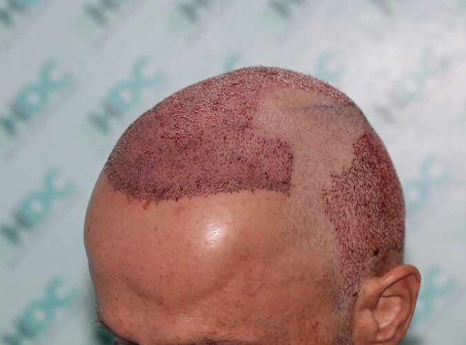 Hair Transplant Outcome with 4000 Grafts Across NW5 Zone – HDC Hair Clinic photo