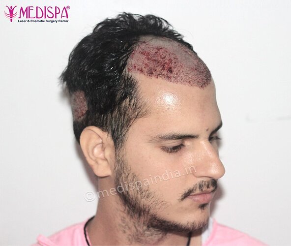 Dr. Suneet Soni - 2500 FUE Grafts, NW- III photo