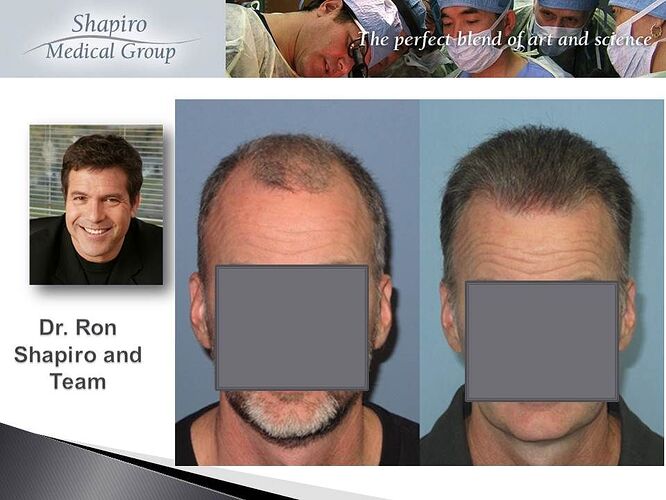 Dr. Ron Shapiro – 6177gr/11,939hairs in 2 Strip sessions – NW6 photo