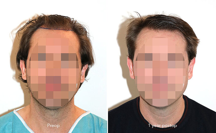 Case performed by Dr. Feriduni – 3322 FU in 1 procedure photo