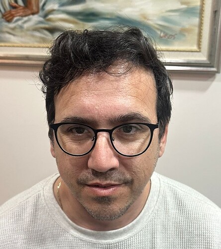 HDC Hair Clinic – FUE Hair Transplant Result for 4534 Grafts photo