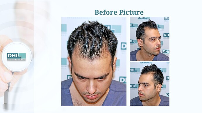 DHI India™ | NW 3 | 1,504 Grafts | 5 Months DHI Hair Transplant Results photo
