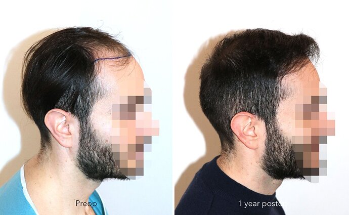 Case performed by Dr. Feriduni – 3744 FU in 1 procedure photo