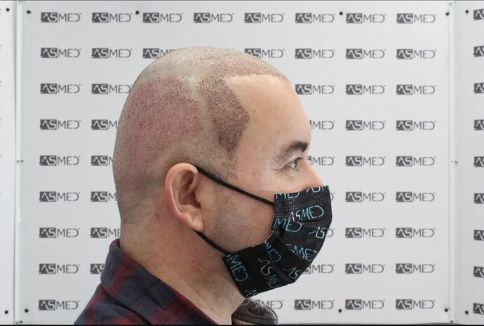ASMED CLINIC - DR.KORAY - 5060 GRAFTS FUE photo