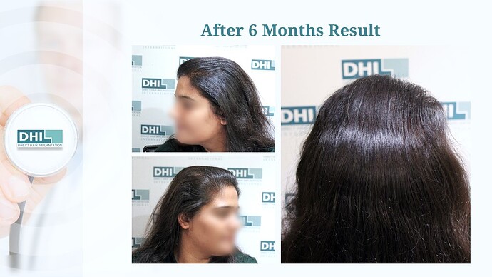 Female Hair Transplant | 1,359 Grafts | 6-Months Result | DHI India™ photo