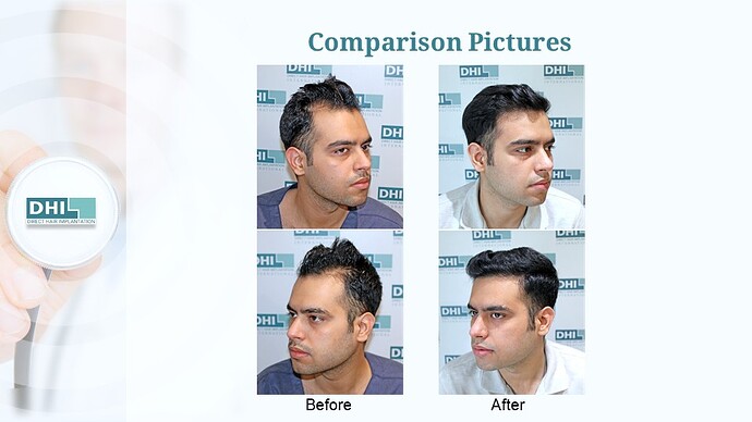 DHI India™ | NW 3 | 1,504 Grafts | 5 Months DHI Hair Transplant Results photo