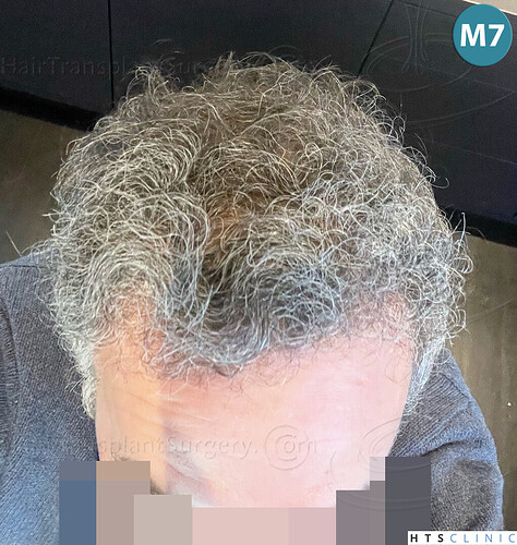 Dr Devroye + Dr Montesanti + Dr Jenard, HTS Clinic / 2932 FUE / Hairline & frontal area photo