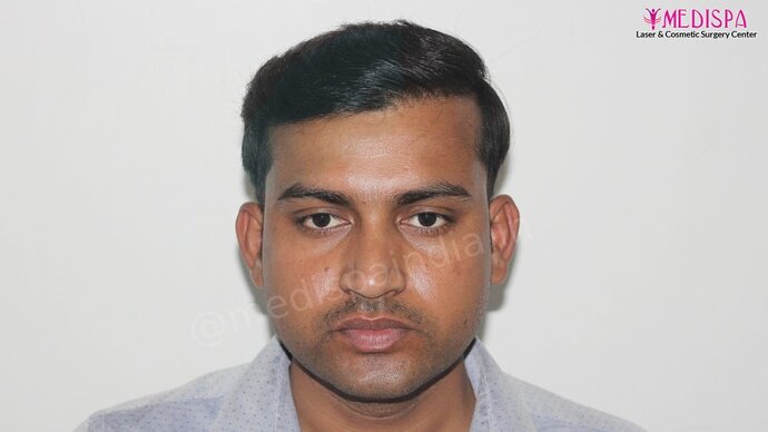 Dr. Suneet Soni - 5587 Grafts, Combine FUT + FUE + Beard Technique, NW : V-VI photo