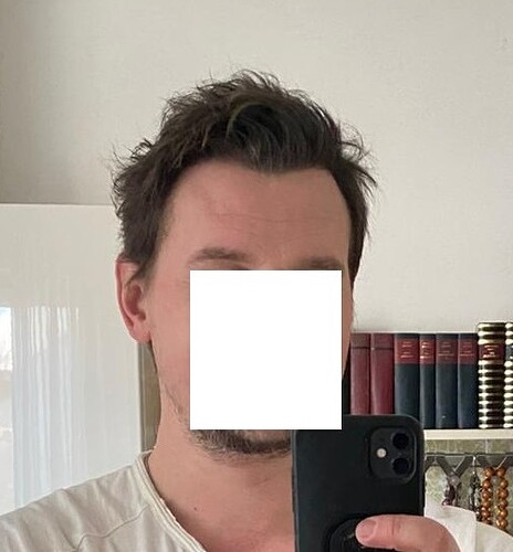 Hairline FUE Result for 2500 Grafts – 8 Months After – HDC Hair Clinic photo