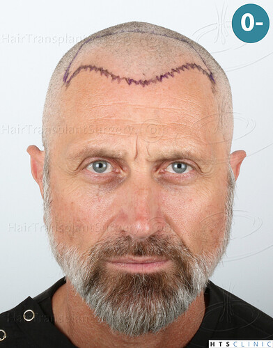 Dr. Jean Devroye, HTS Clinic / 2252 FUE / Hairline restoration photo