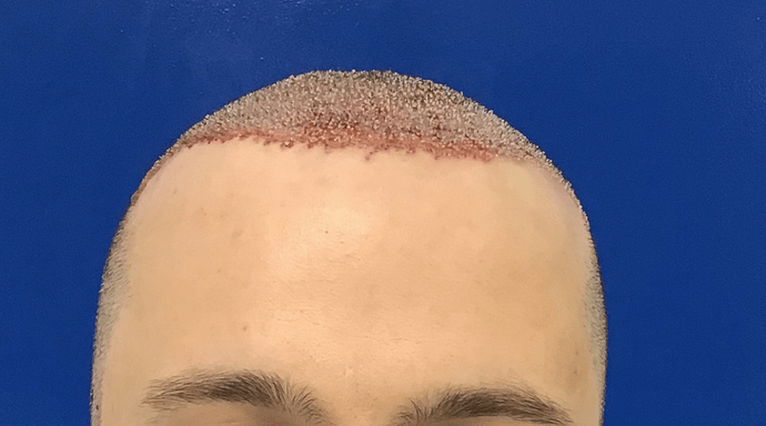 Dr.Bisanga & Dr.Kostis, BHR Clinic, 3460 FUE 0 - 8 MONTHS photo