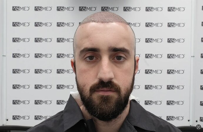 ASMED CLINIC CASE - DR.KORAY 5000 GRAFTS FUE photo