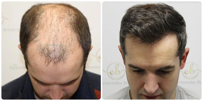 Dr Bonaros, Glasgow, UK / 4033 FUE grafts / 0-12 Months photo