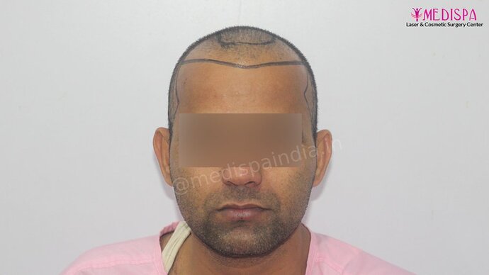 Dr. Suneet Soni - 4025 Grafts | 12-Month Result | Combination FUT + FUE photo