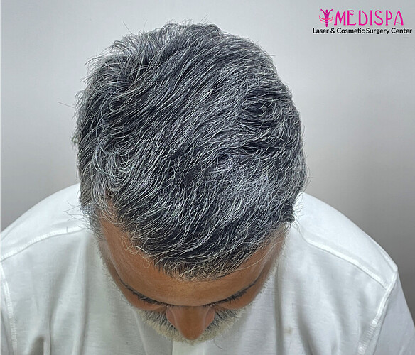 Dr. Suneet Soni - 4190 Grafts, Combine FUT + FUE + Beard Technique, NW- III photo